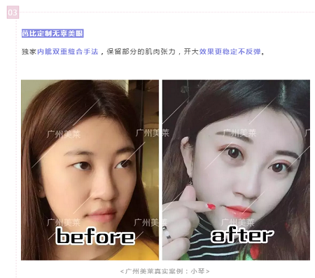 腫眼泡？重內(nèi)眥？