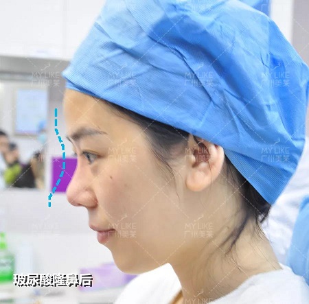 玻尿酸，僅需？80！