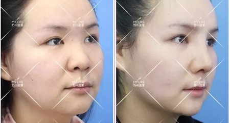 想隆鼻又不想用自己的軟骨，急需一個(gè)男票！