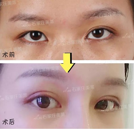 明星的眼和鼻，術(shù)后半個(gè)月Get專業(yè)混血臉！可萌可酷美翻了~
