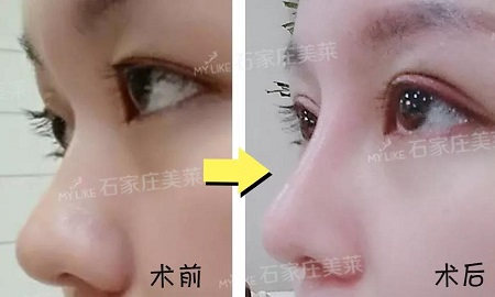 術(shù)后半個(gè)月Get專業(yè)混血臉！可萌可酷美翻了~
