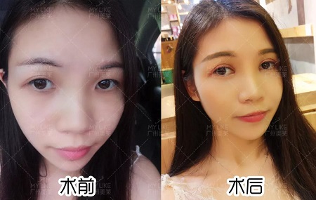 天生雙眼皮卻不好看？原因原來出在這！