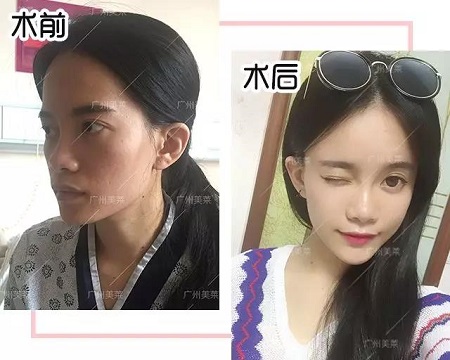 脂肪填一填，臉竟從“喪到爆”變“萌出血”！