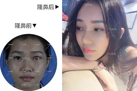 你的臉型，適合直鼻or翹鼻？