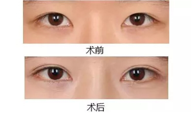 南京做韓式三點(diǎn)雙眼皮價(jià)錢是多少？