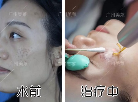 職場上的女強人，偏偏擺不平臉上這斑斑點點...