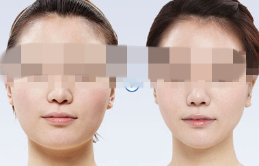 適合面部吸脂整形的人多嗎？