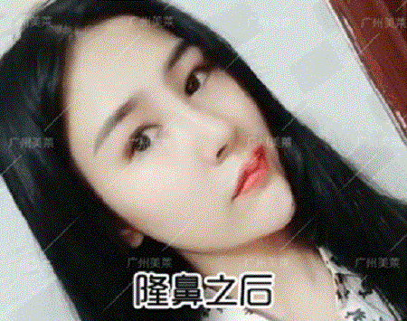 隆了個(gè)鼻，臉竟瘦了1圈？