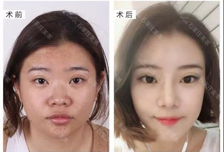 做完鼻整形，顏值逆風(fēng)翻盤！