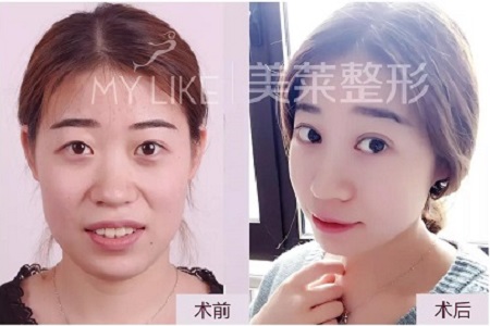 這幾種眼睛割完雙眼皮超美！不信，看她們的術(shù)后效果~