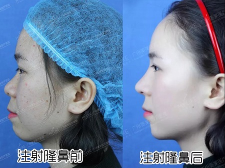 玻尿酸即刻效果多明顯？！