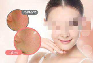 重慶激光美白費(fèi)用多少？