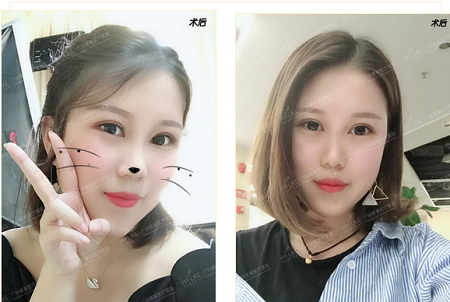 雙眼皮貼10年，割1刀，美20倍！