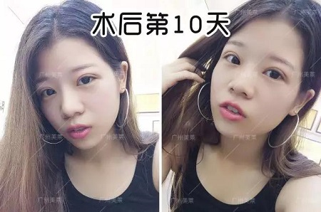 割雙眼皮后都可以出道了！