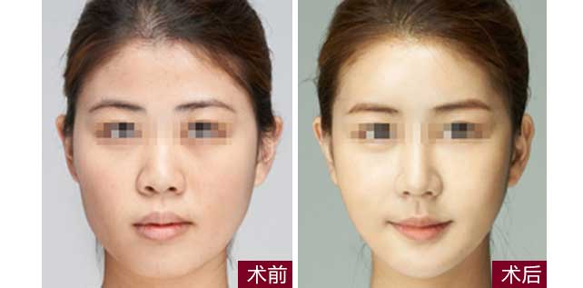 瘦臉一針需要多少錢？