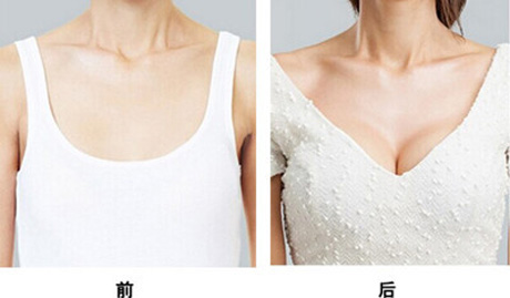 做隆胸大概費用多少？