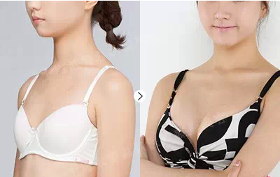 假體豐胸能保持幾年？