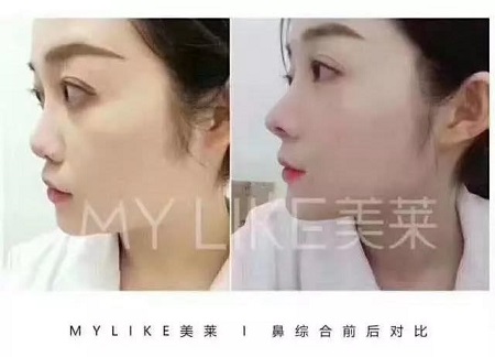 做鼻整形要謹(jǐn)記這些“后遺癥”！