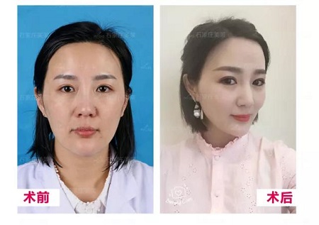 松弛的臉做完*雕，比同齡人足足年輕10歲！
