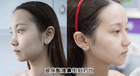 隆鼻價(jià)格內(nèi)幕曝光！水超深！