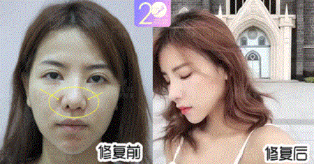 深扒 | 隆鼻價(jià)格內(nèi)幕曝光！水超深！