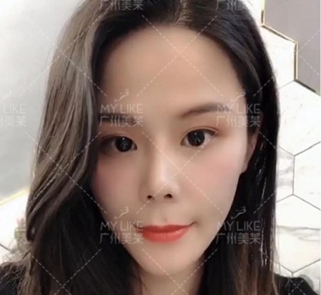 速美打造神奇——玻尿酸，讓你蛻變！