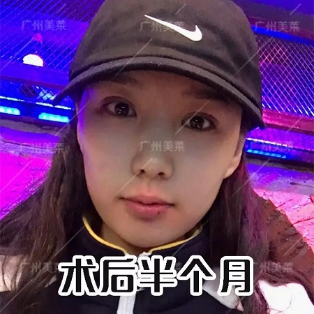 下垂眼割無辜桃花眼后，美成咋樣了？