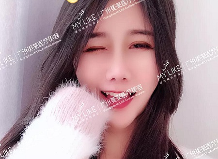3個小姐姐真實分享，肋軟骨隆鼻感受！
