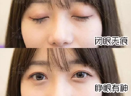 陰森小眼<a href='/ybzx/syp/' target='_blank'><u>割雙眼皮</u></a>后7天，竟如小鹿般精靈可愛？