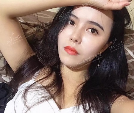 隆鼻后逆襲成女神？