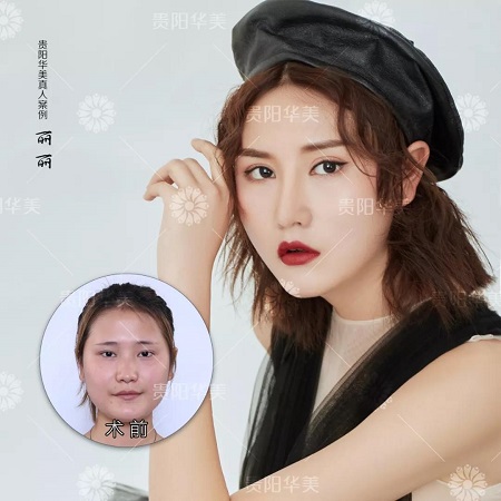 會縫衣服就會割雙眼皮！3天速成還用朋友試手？