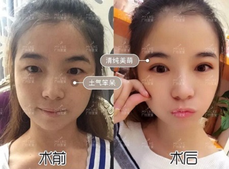 割完雙眼皮氣質(zhì)大變身?。?！