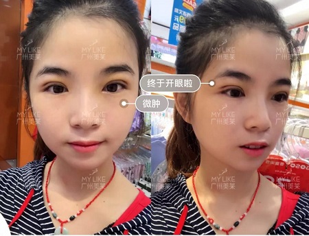 割完雙眼皮氣質(zhì)大變身！??！