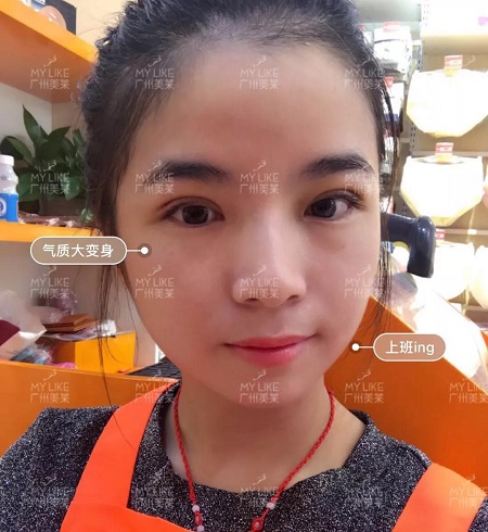 割完雙眼皮氣質(zhì)大變身?。?！