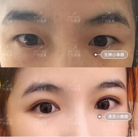 割完雙眼皮氣質(zhì)大變身?。?！