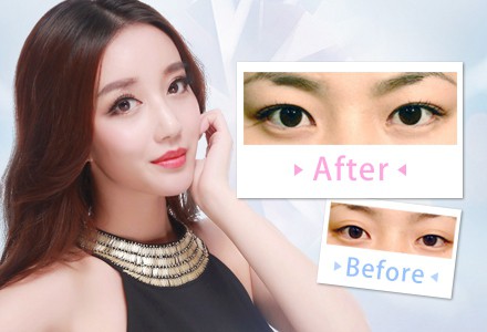 做個(gè)雙眼皮的價(jià)格要多少錢？
