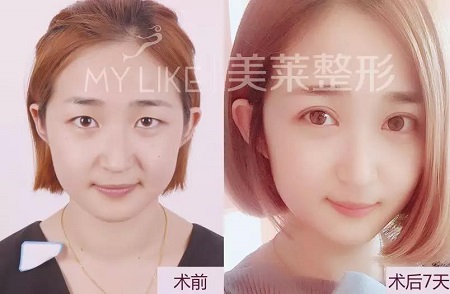 美萊眼部整形醫(yī)師—畢小麗主任，3月23日親診石家莊美萊。
