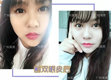 懵豬小眼割雙眼皮后，睜眼美到跪！