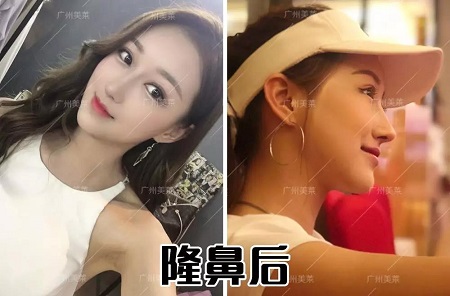 隆鼻3天后，從素人撞臉關(guān)曉彤？