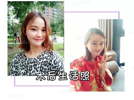 我近視做雙眼皮，對眼睛有影響嗎？圍觀小姐姐術后反饋！
