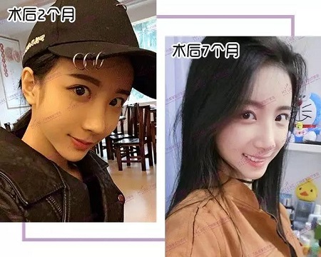 鼻修復(fù)7個(gè)月后，朝天鼻蛻變驚艷，側(cè)顏美炸天！