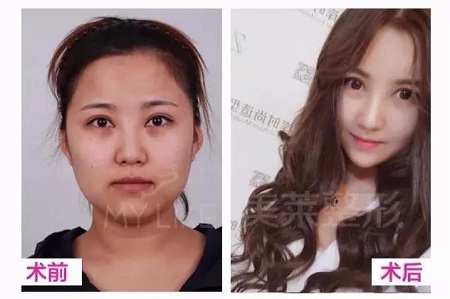 鼻子有這2個bug，影響顏值又顯老！