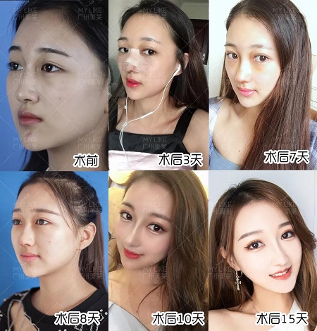 隆鼻后7天拆線，10天上妝美炸天！