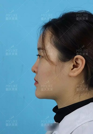 “鼻綜合”后假又歪，還攣縮？鼻修復(fù)還原自然生態(tài)美鼻