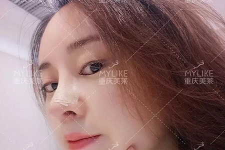 “鼻綜合”后假又歪，還攣縮？鼻修復(fù)還原自然生態(tài)美鼻