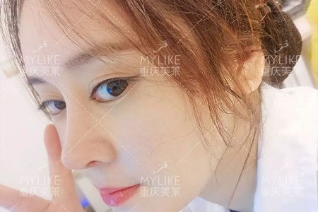 “鼻綜合”后假又歪，還攣縮？鼻修復(fù)還原自然生態(tài)美鼻