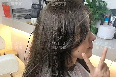 “鼻綜合”后假又歪，還攣縮？鼻修復(fù)還原自然生態(tài)美鼻