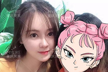 “鼻綜合”后假又歪，還攣縮？鼻修復(fù)還原自然生態(tài)美鼻