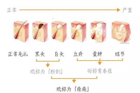 擠痘竟然被送進(jìn)ICU！你的痘痘還好嗎？
