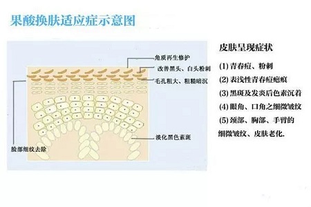 擠痘竟然被送進(jìn)ICU！你的痘痘還好嗎？